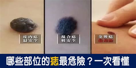 女生長痣|痣是什麼？會變成黑色素瘤？7種一定要除的痣